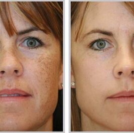Top 9 thành phần điều trị nám tốt nhất cho da mặt bạn